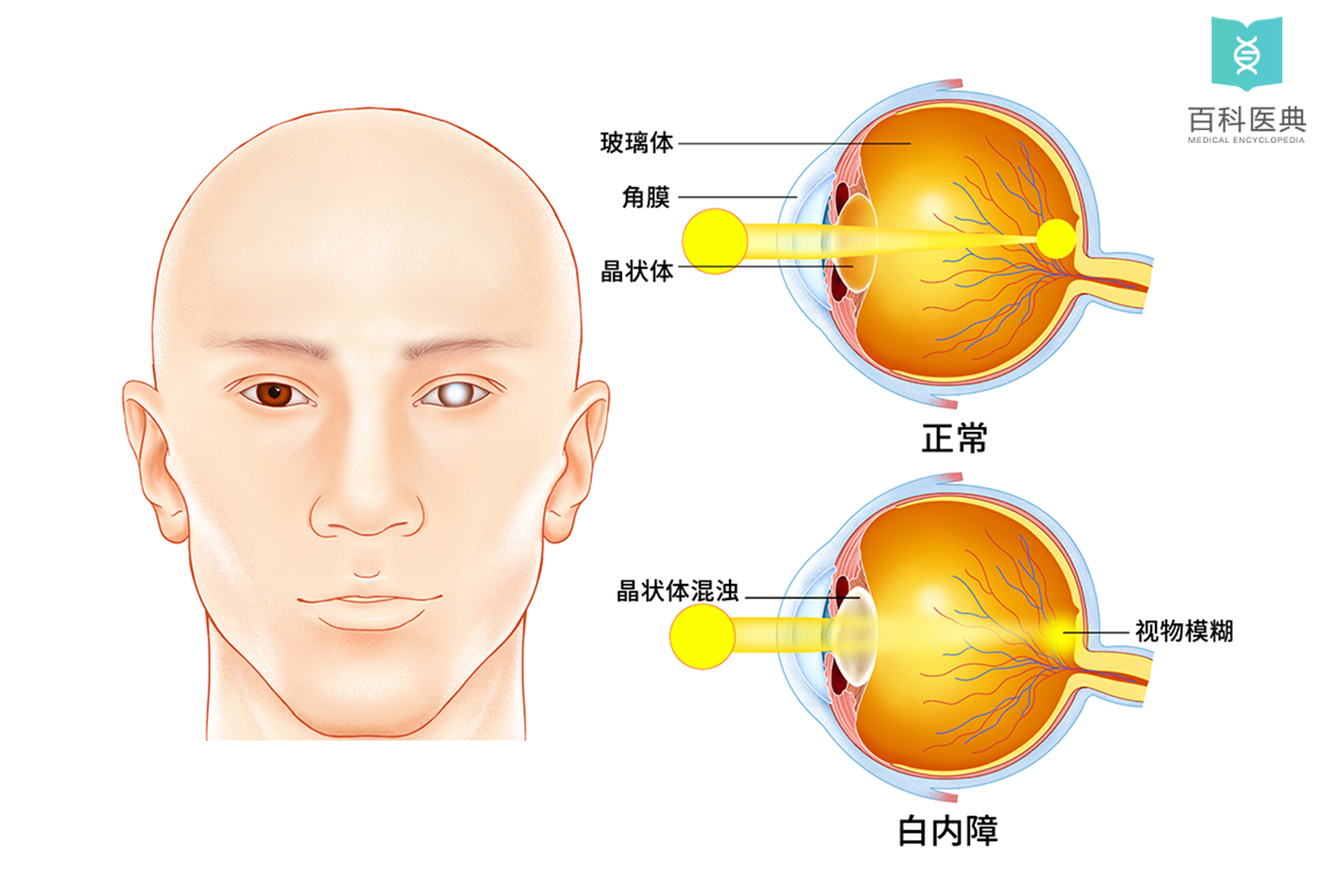 沧州近视手术